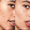 imageelf SKIN Blemish Breakthrough Acne Fighting Spot Gel Rollon For Treating Blemishes Made With Salicylic Acid Vegan ampamp CrueltyFree