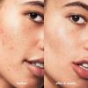 imageelf SKIN Blemish Breakthrough Blemish Control Basics Kit TravelSize Acne Skincare Routine Cleanser Serum ampamp Moisturizer Vegan ampamp CrueltyFree